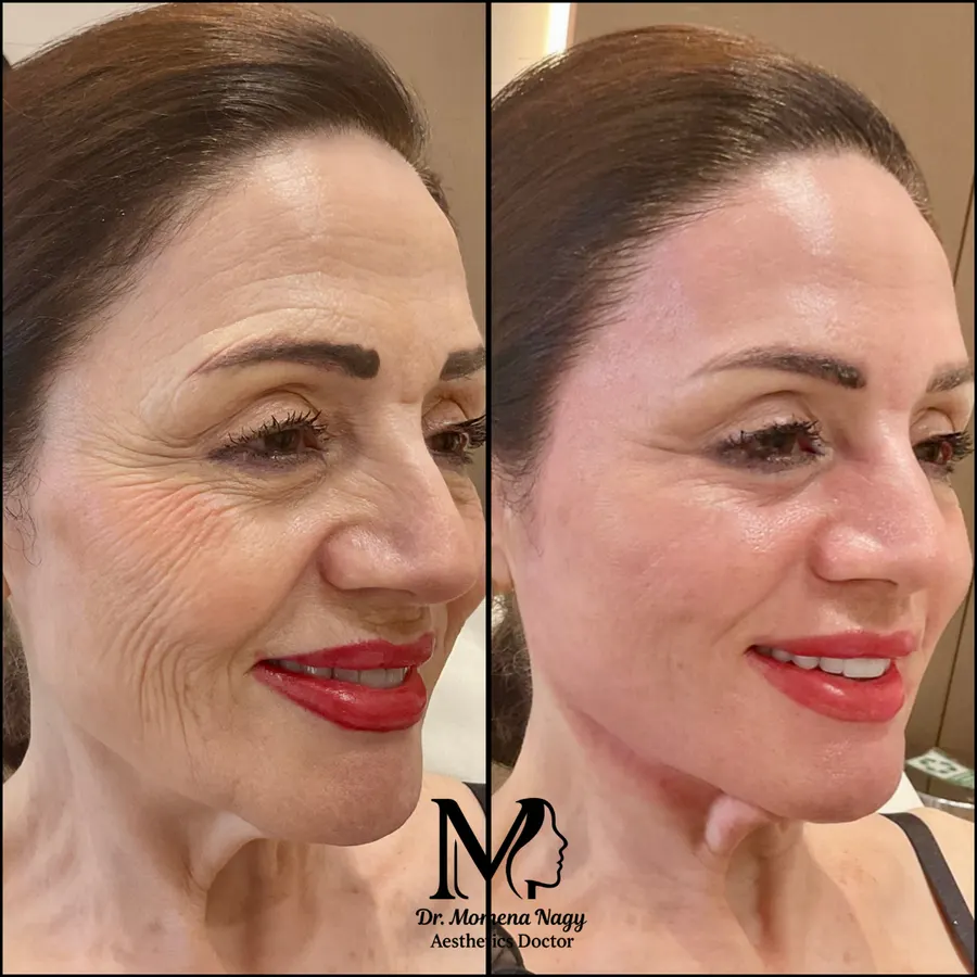 Full-face rejuvenation — before and after