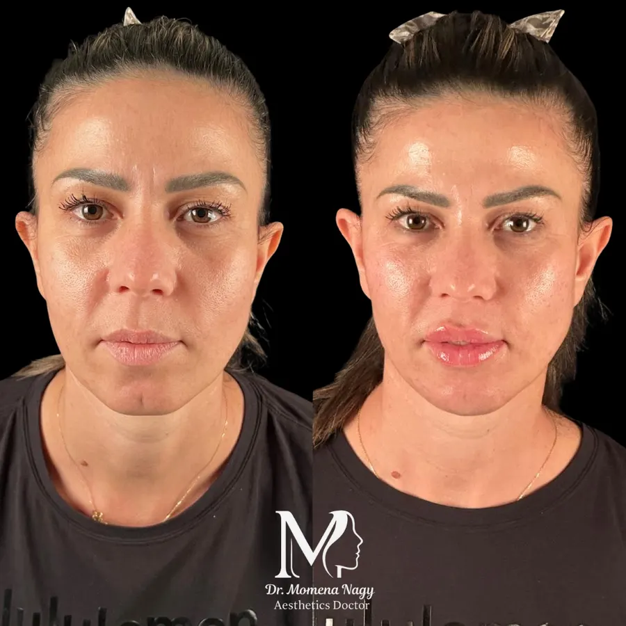 Skin quality and brightness — before and after