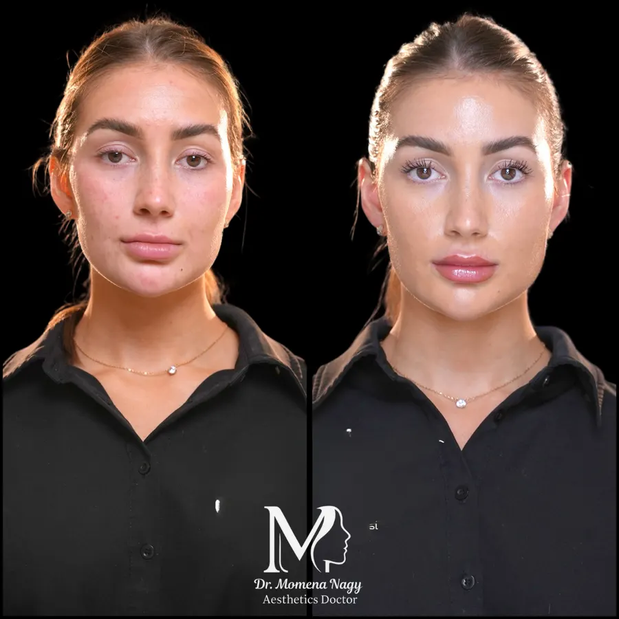 Facial balance and lips — before and after