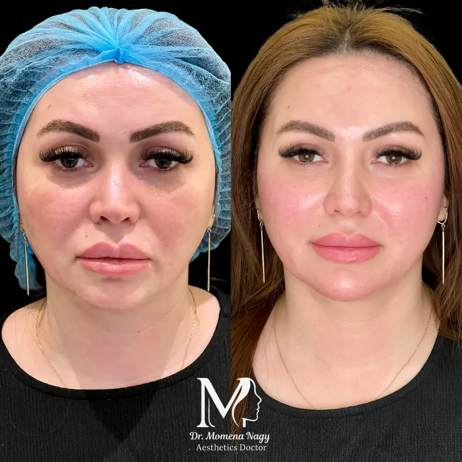 Contour and definition — before and after