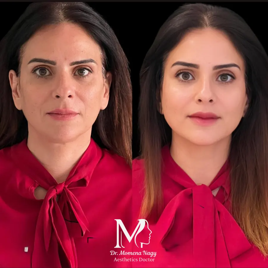 Refreshed, rested look — before and after