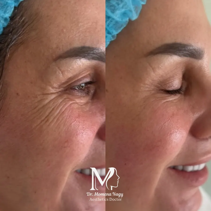 Fine lines around the eyes — before and after