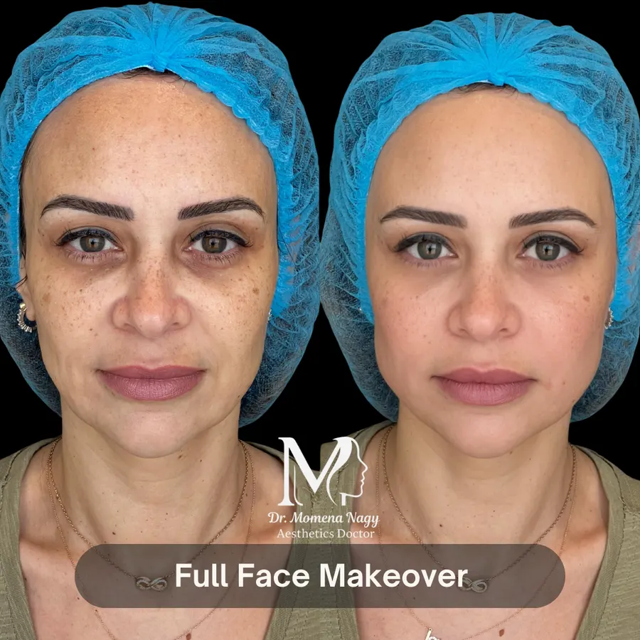 Full face makeover — before and after
