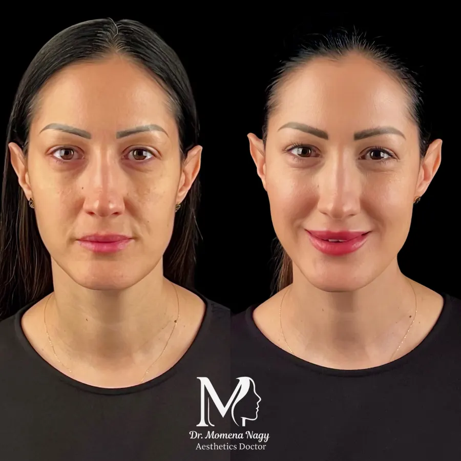 Subtle lift and glow — before and after