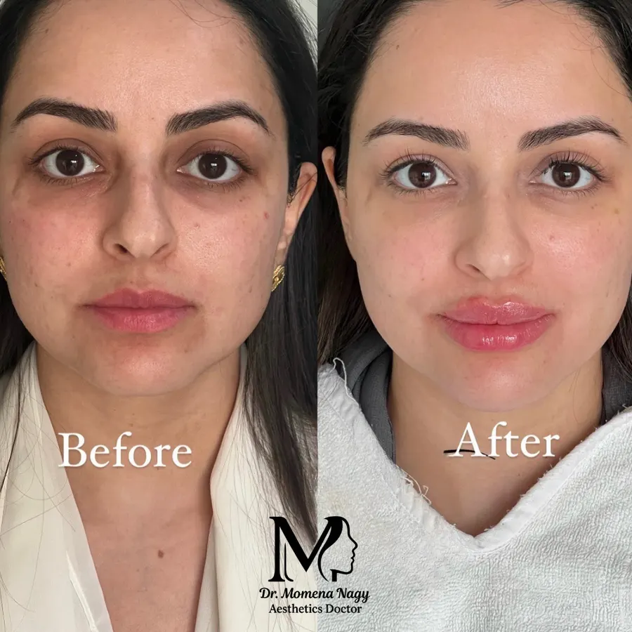 Under-eye and skin tone — before and after