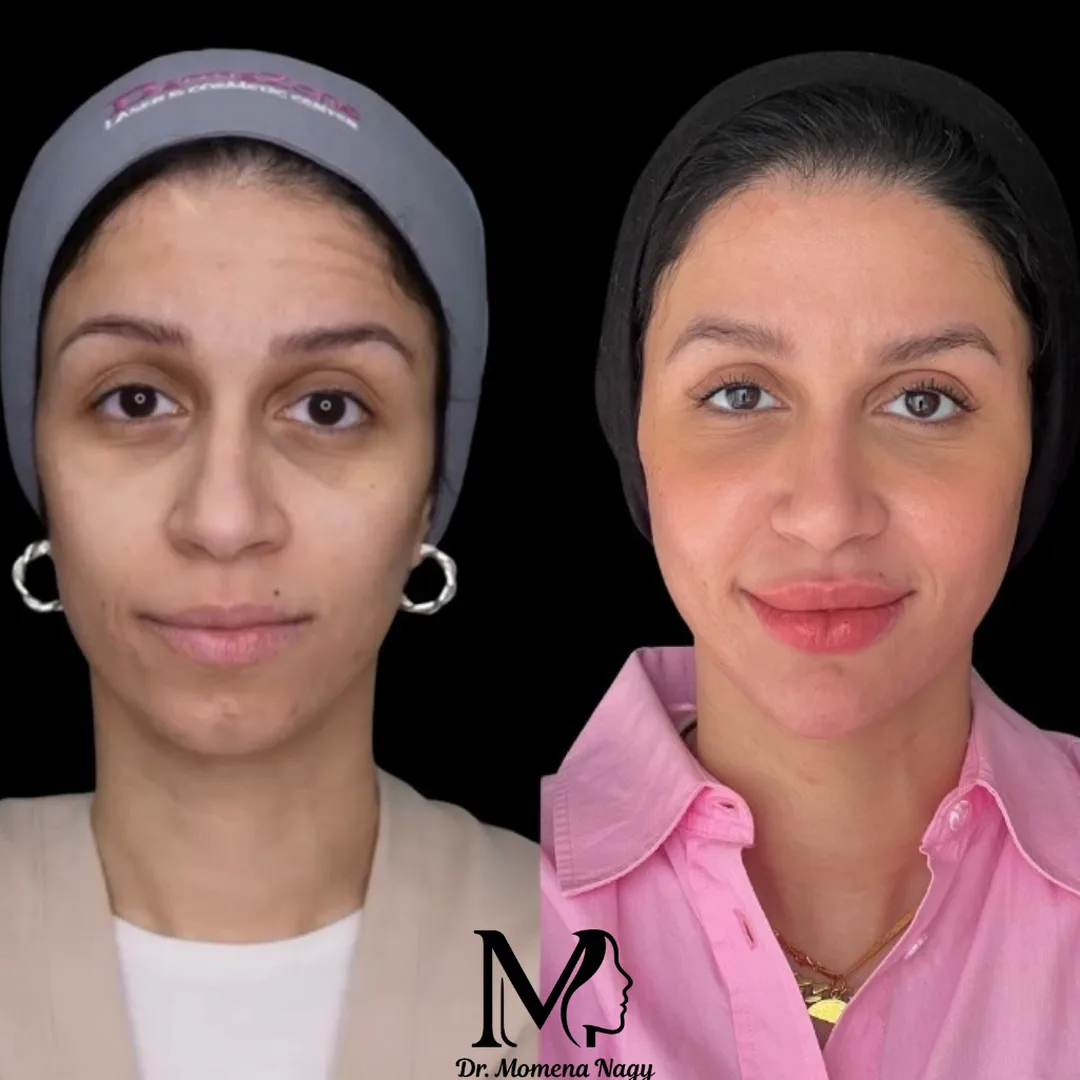 Brighter, more even complexion — before and after